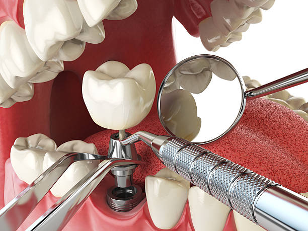 Best Urgent Care for Lost Fillings or Crowns in Hanover, PA
